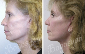 Подтяжка лица (фейслифтинг)