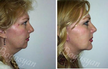 Подтяжка лица (фейслифтинг)