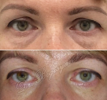 Трансконъюктивальная блефаропластика нижних век