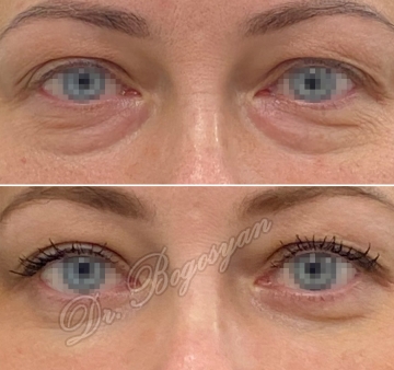 Трансконъюктивальная блефаропластика нижних век