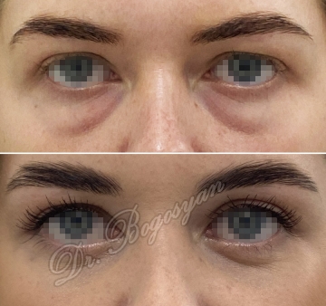 Трансконъюктивальная блефаропластика нижних век