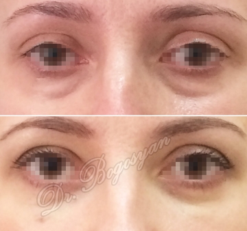 Трансконъюктивальная блефаропластика нижних век