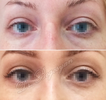 Трансконъюктивальная блефаропластика нижних век