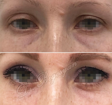 Трансконъюктивальная блефаропластика нижних век