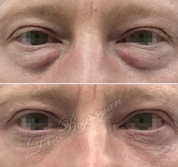 Трансконъюктивальная блефаропластика нижних век