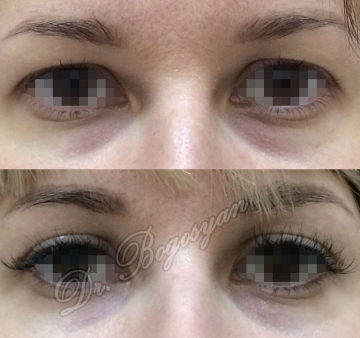 Блефаропластика верхних век