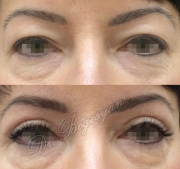 Блефаропластика верхних век