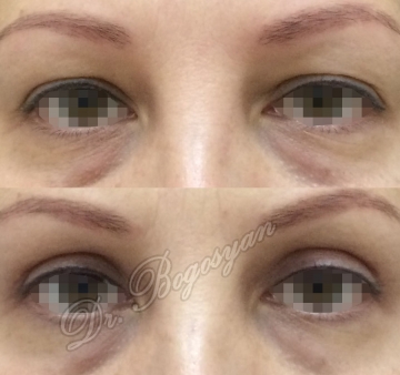 Блефаропластика верхних век