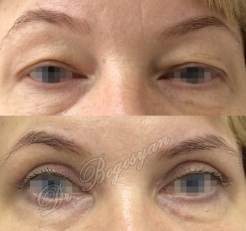 Блефаропластика верхних век