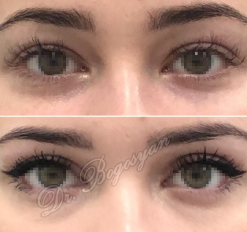 Блефаропластика верхних век