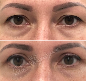 Блефаропластика верхних век