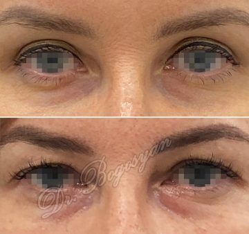 Блефаропластика верхних век