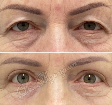 Блефаропластика верхних век