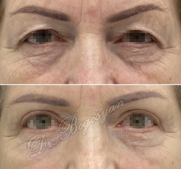 Блефаропластика верхних век