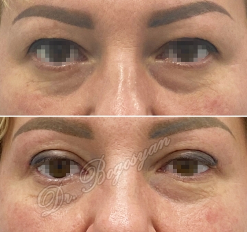 Блефаропластика верхних век