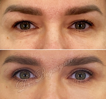 Блефаропластика верхних век