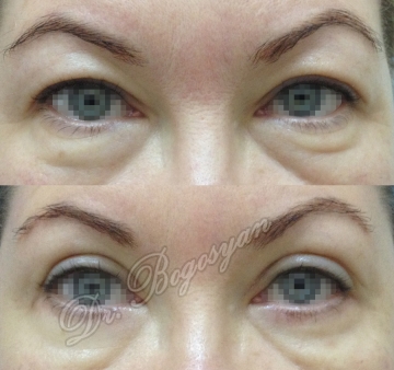 Блефаропластика верхних век