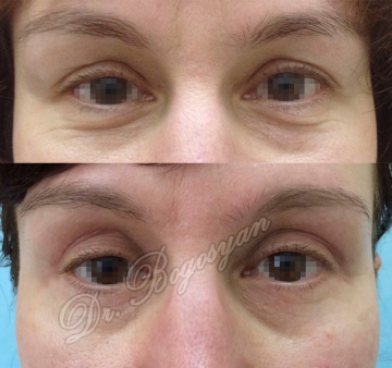 Блефаропластика верхних век