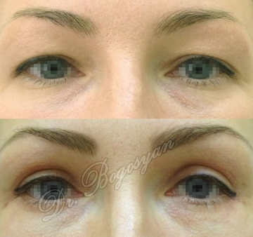 Блефаропластика верхних век