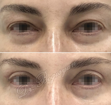 Блефаропластика верхних век