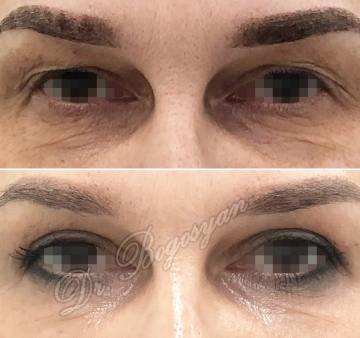 Блефаропластика верхних век