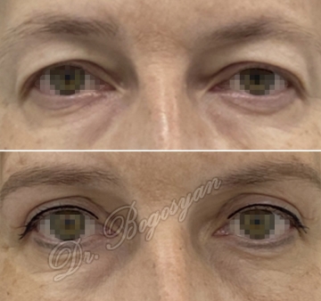 Блефаропластика верхних век