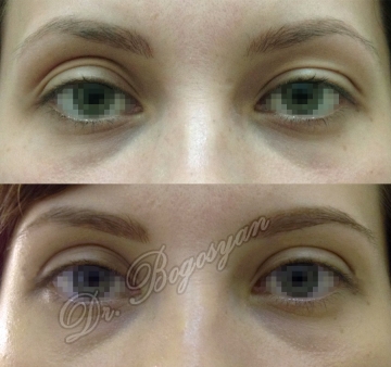 Блефаропластика верхних век