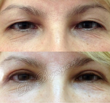 Блефаропластика верхних век