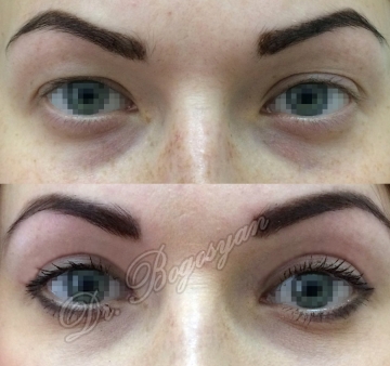 Блефаропластика верхних век