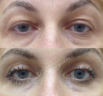 Блефаропластика верхних век