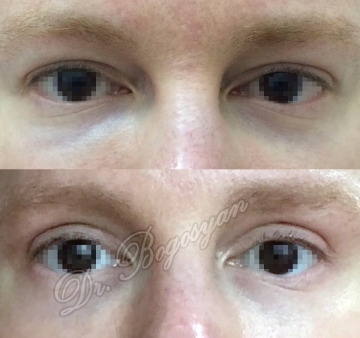 Блефаропластика верхних век