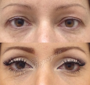 Блефаропластика верхних век