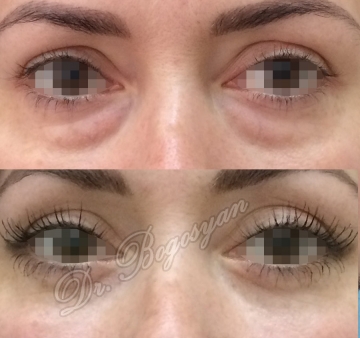 Блефаропластика нижних век