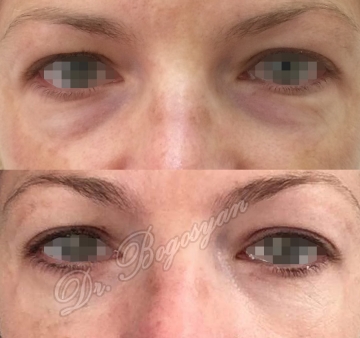 Блефаропластика нижних век