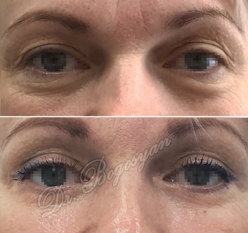 Блефаропластика нижних век