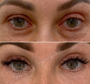 Блефаропластика нижних век