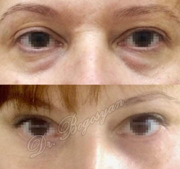 Блефаропластика нижних век