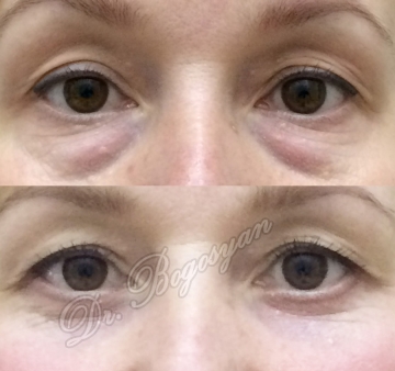 Блефаропластика нижних век