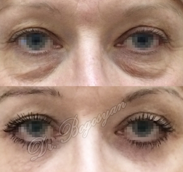 Блефаропластика нижних век