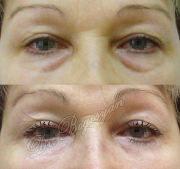 Блефаропластика нижних век
