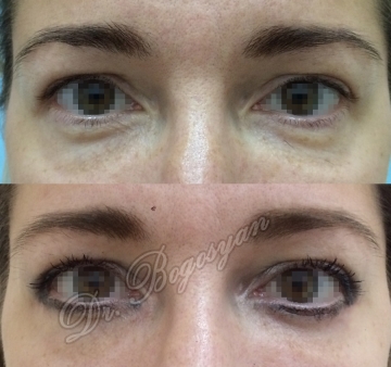 Блефаропластика нижних век