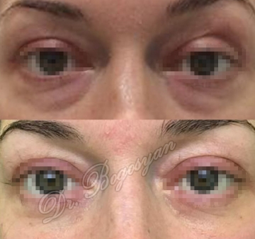 Блефаропластика нижних век