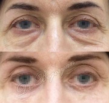 Блефаропластика нижних век