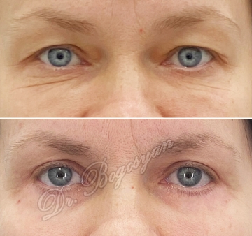 Блефаропластика верхних и нижних век