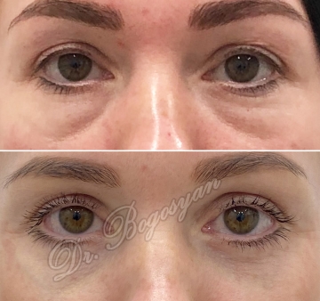 Блефаропластика верхних и нижних век