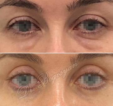 Блефаропластика верхних и нижних век