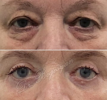 Блефаропластика верхних и нижних век