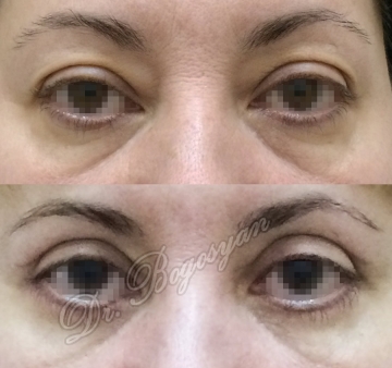 Блефаропластика верхних и нижних век