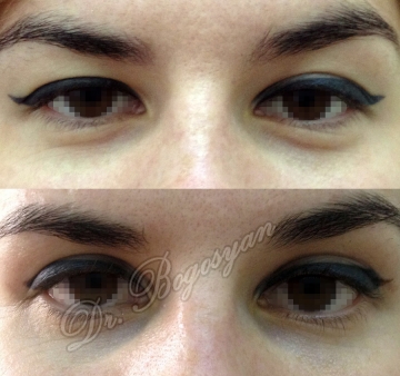 Блефаропластика верхних и нижних век