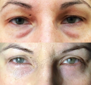 Блефаропластика верхних и нижних век